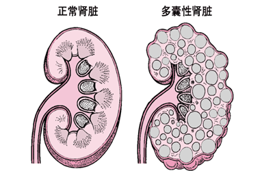 试管能避免遗传多囊肾吗遗传多囊肾一般能活到多少岁