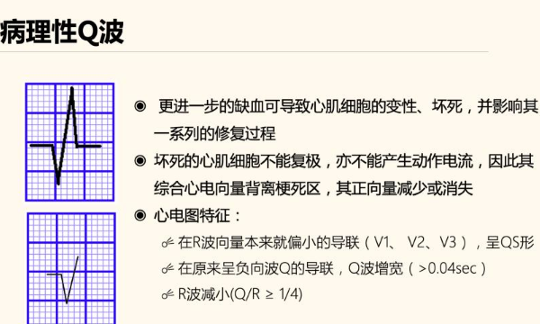 心电图三级q波异常影响试管吗