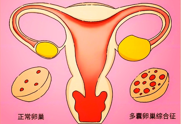 30岁多囊试管做几代胚胎质量比较好多囊女性的卵子质量情况